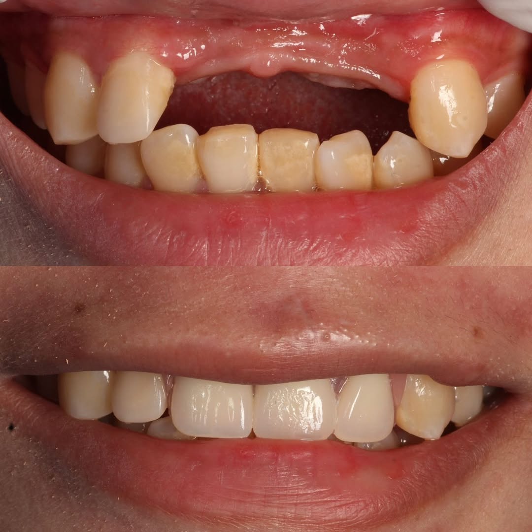 Two photographs of the same patient. Above: upper front teeth missing, with a gap in the gum line. Below: the gap restored, the smile even and complete.