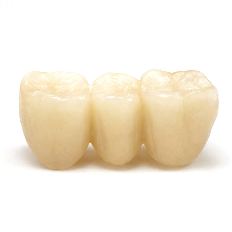 A three-unit ceramic dental bridge